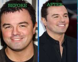 Seth MacFarlane before surgery